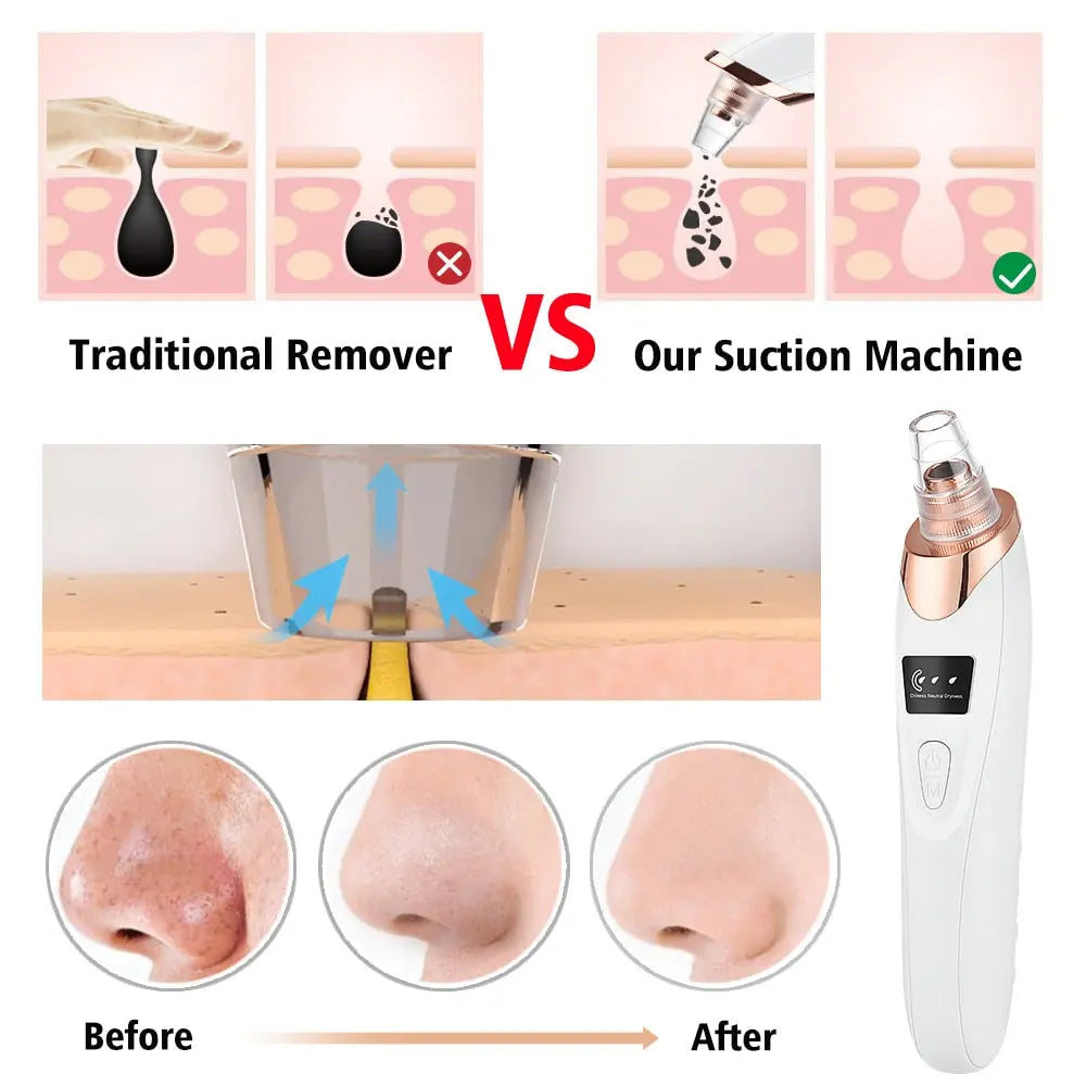 Vacuum Electric Blackhead Remover Cleaner - GLR SHOPPING